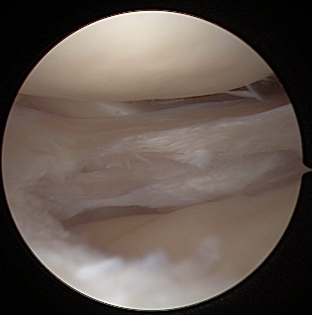 Išorinio menisko degeneracinio horizontalaus plyšimo rekonstrukcija: biologinis pagrindimas ir klinikiniai rezultatai