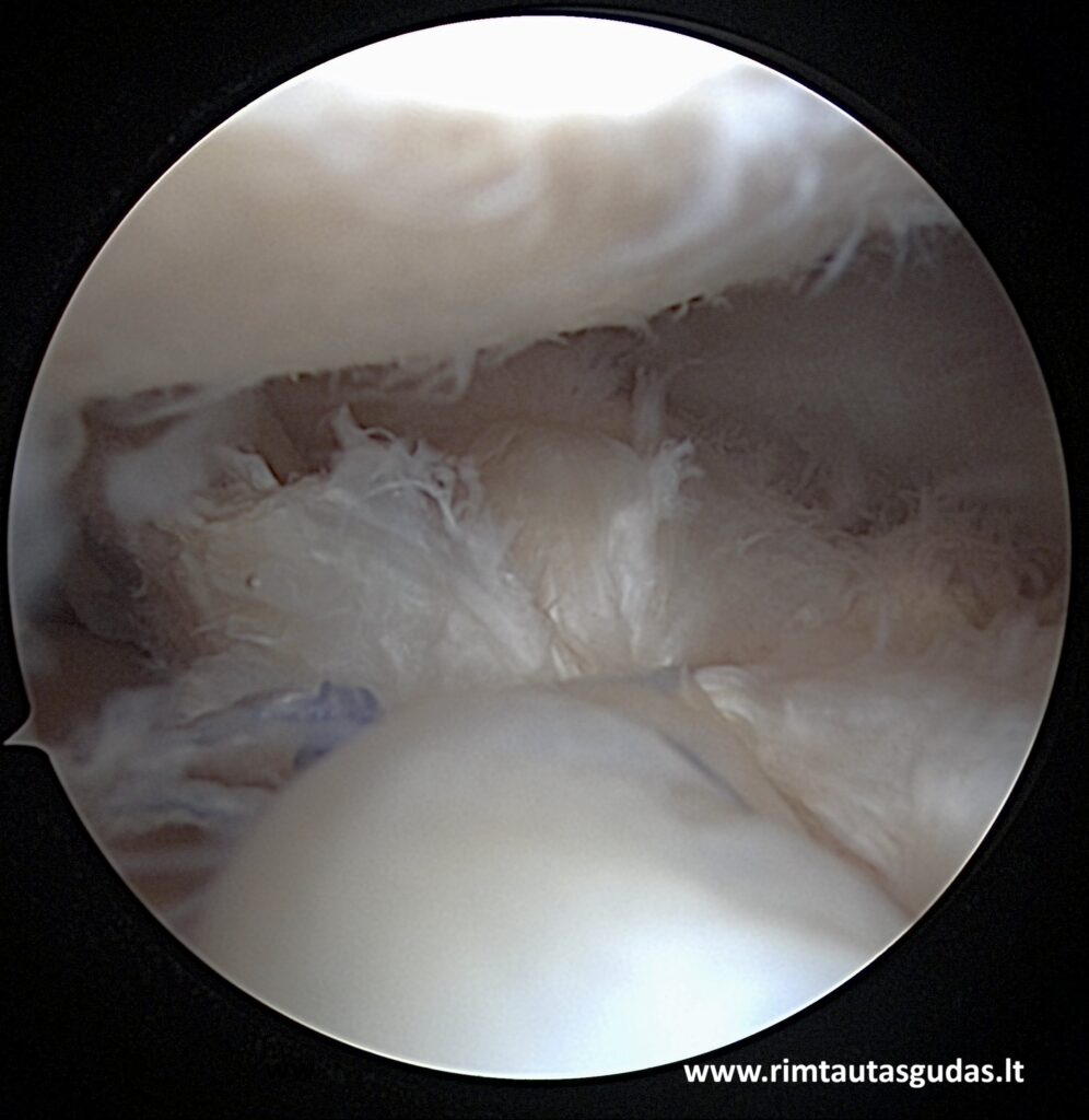 Išorinio menisko degeneracinio horizontalaus plyšimo rekonstrukcija: biologinis pagrindimas ir klinikiniai rezultatai