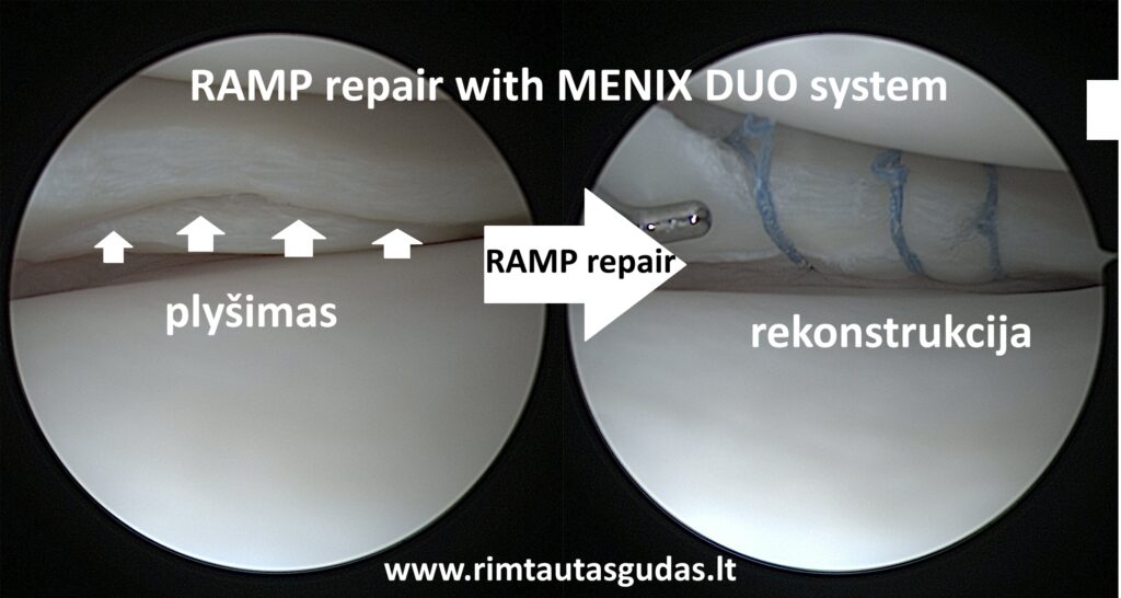 RAMp Menix Duo