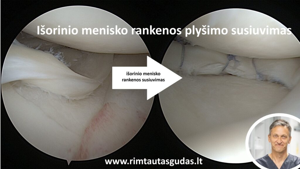 lateral meniscus bucket handle tear R.Gudas