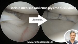 lateral meniscus bucket handle tear R.Gudas