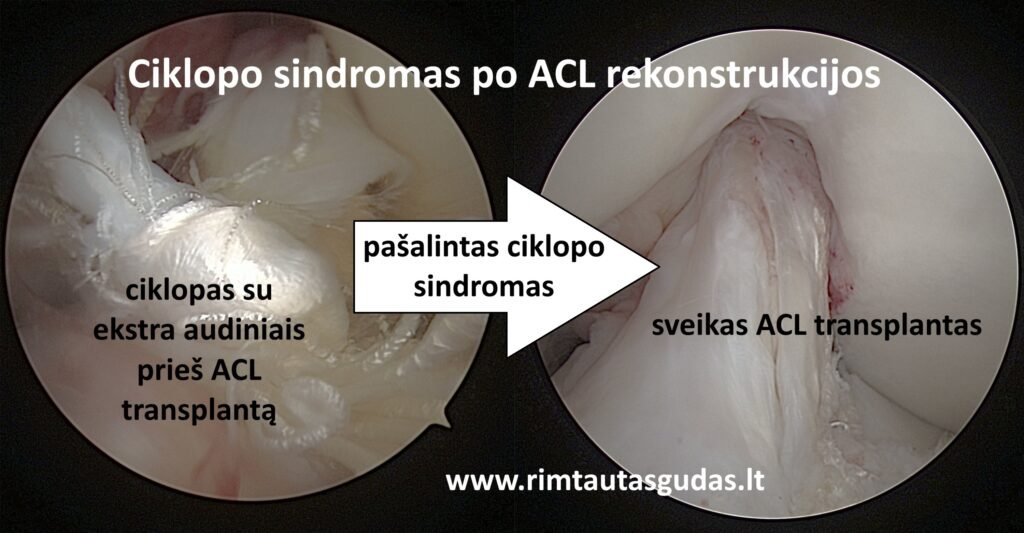 ACL ciklopas