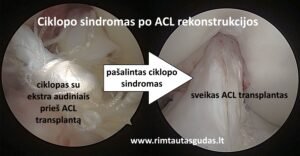 ACL ciklopas