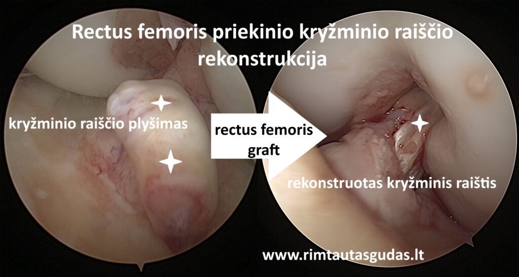 PKR rekonstrukcija su Rectus Femoris transplantu 3 PKR rekonstrukcija su Rectus Femoris transplantu