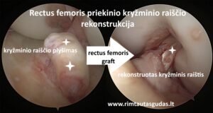 Rectus femoris ACLR R.Gudas